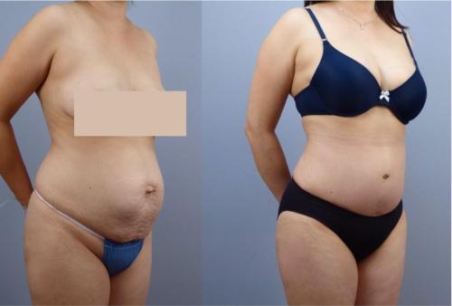 ABDOMINOPLASTIA