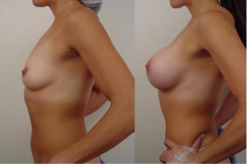 AUMENTO DE BUSTO CON IMPLANTES REDONDOS