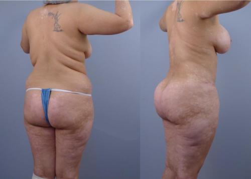 AUMENTO DE GLUTEOS CON GRASA