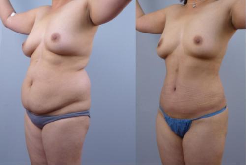 ESTETICA DE ABDOMEN CON LIPOSUCCION