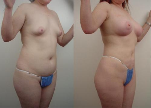ESTETICA DE BUSTO_ ABDOMINOPLASTIA