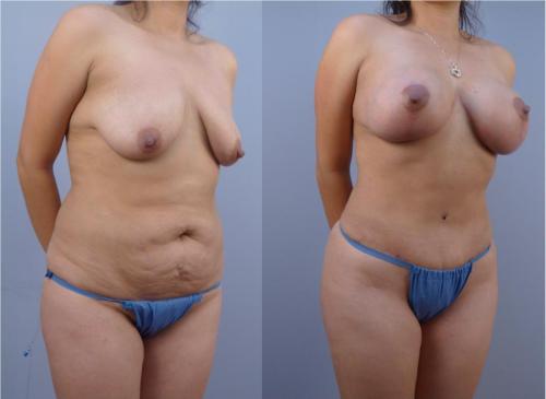 IMPLANTE DE BUSTO_ MASTOPEXIA_ ABDOMINOPLASTIA