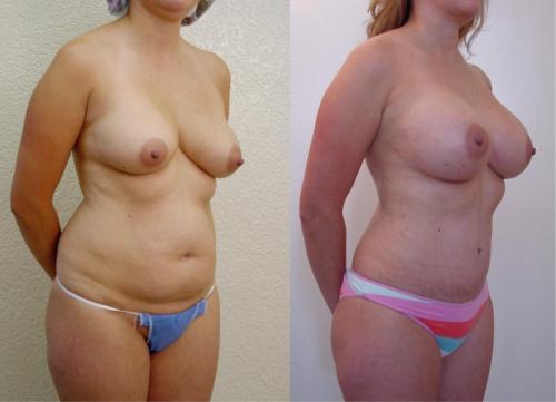 IMPLANTES_ ABDOMINOPLASTIA_ LIPOSUCCION