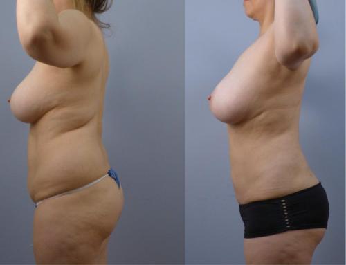 LIPOSUCCION CORPORAL