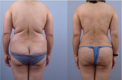 LIPOSUCCION DE ESPALDA