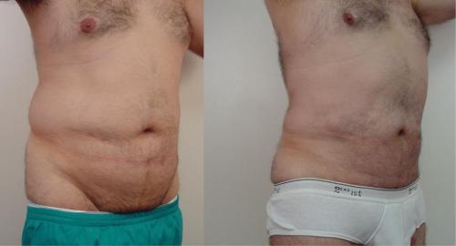 LIPOSUCCION EN HOMBRES