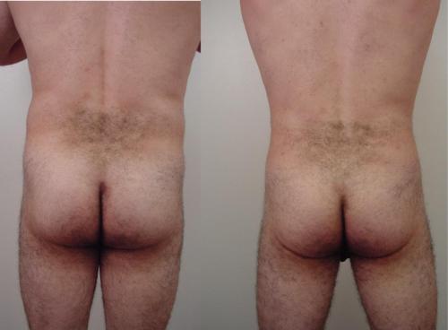 LIPOSUCCION ESPALDA HOMBRES