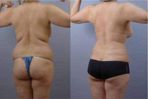 LIPOSUCCION ESPALDA Y AUMENTO DE GLUTEOS