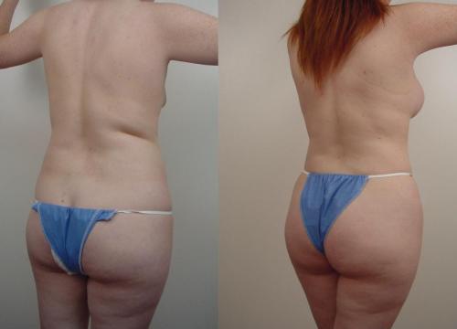 LIPOSUCCION_ AUMENTO DE GLUTEOS