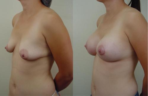 MASTOPEXIA E IMPLANTES