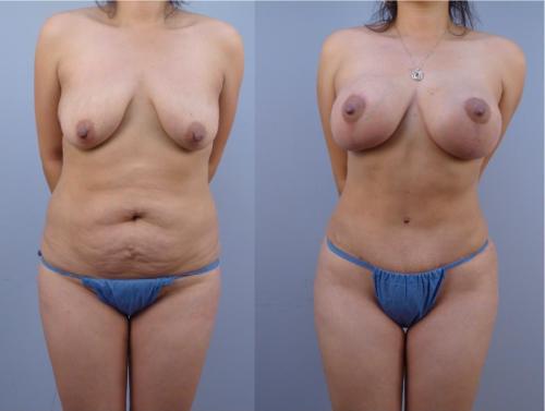 MASTOPEXIA_ ABDOMINOPLASTIA