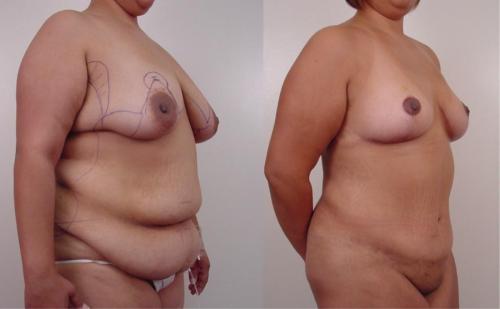 MASTOPEXIA_ CONTORNO CORPORAL